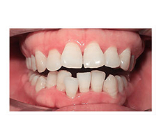 Trước điều trị