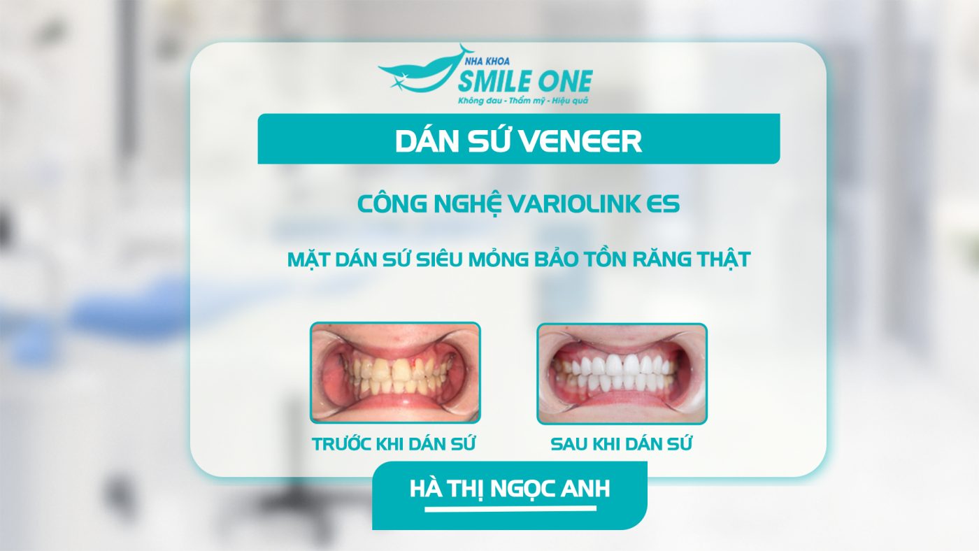 Răng trắng sáng hơn sau tháo niềng với dán sứ Veneer