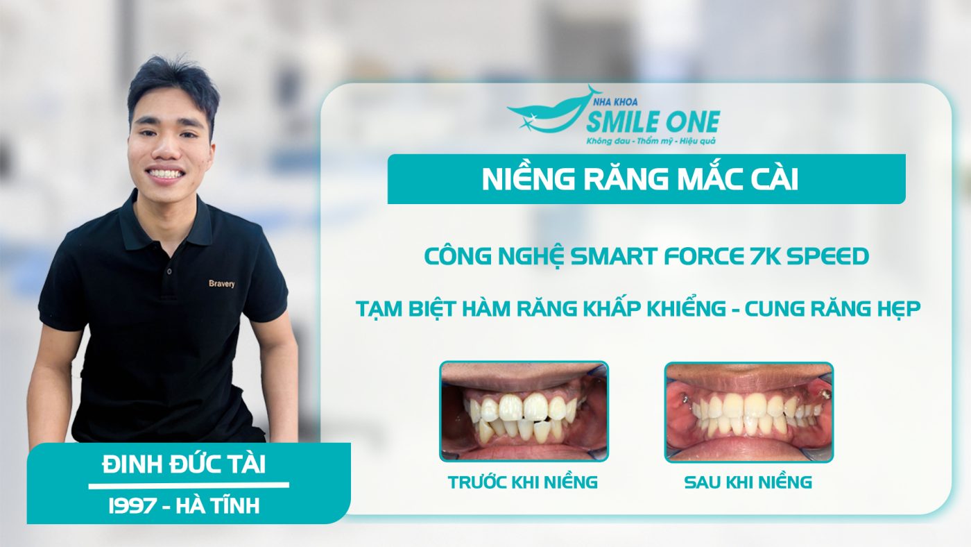 Bạn Đinh Đức Tài và hành trình thay đổi nụ cười với niềng răng mắc cài cùng Ths Bs Nguyễn Tuấn Dương