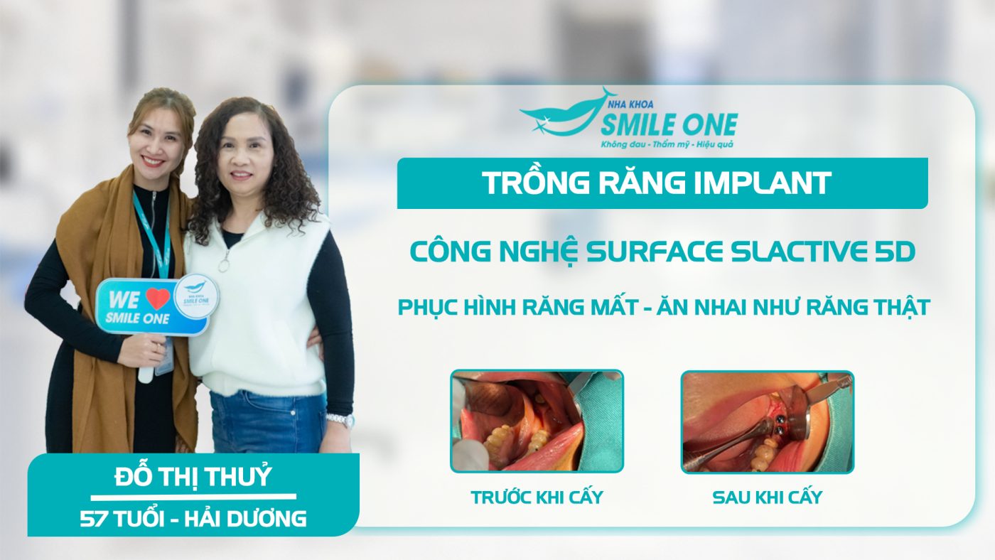 Sau 33 năm mất răng, bác gái từ Hải Dương quyết định trồng răng implant tìm để ăn ngon sống khỏe hơn